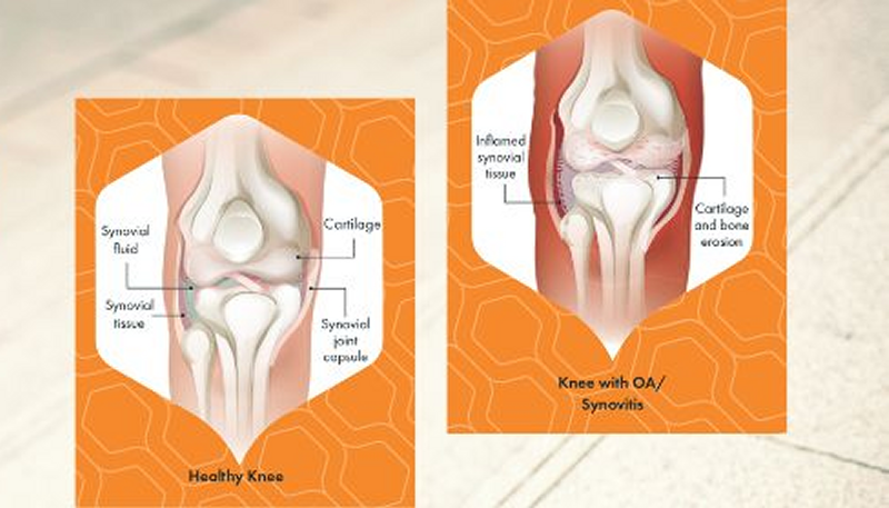 Arthrosamid Knee Joint Graphics800